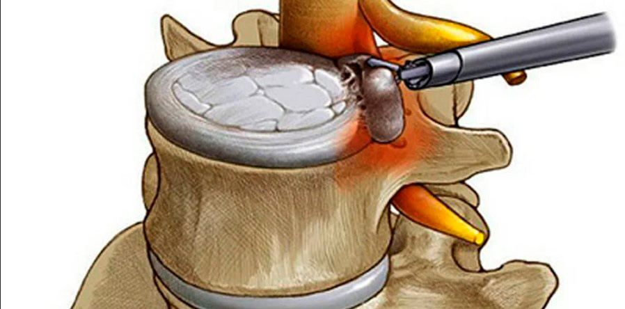 Удаление грыжи в пояснице