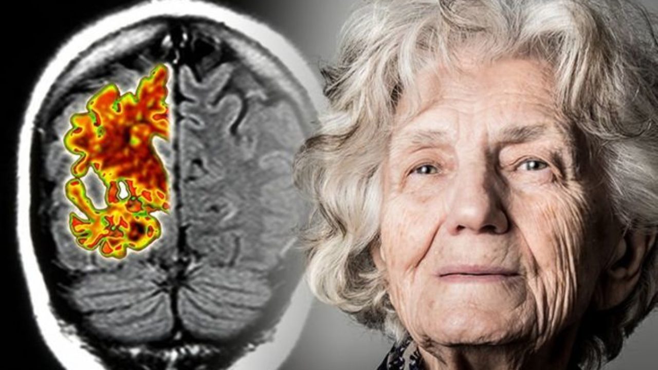 Возрастные изменения мозга. Деменция Альцгеймера. Хвороба Альцгеймера. Мозг пожилых людей.