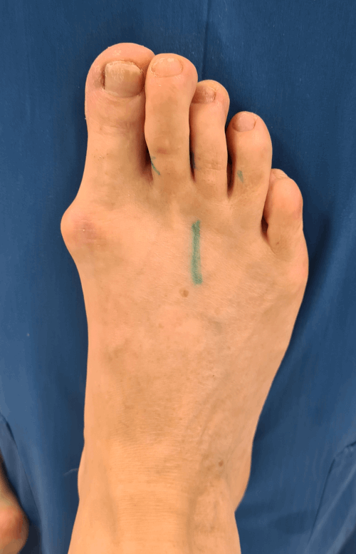 Почему возникает косточка на большом пальце ноги