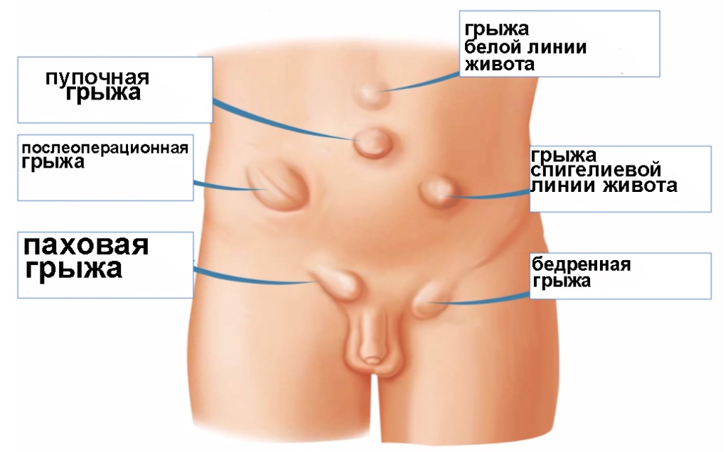 Hernia-Picture.jpg Hernia-Picture.jpg