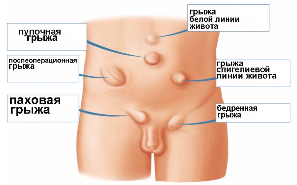 Hernia-Picture.jpg