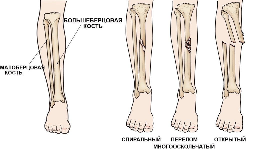 Лечение перелома большеберцовой кости в Киеве по доступной цене в Consilium Medical