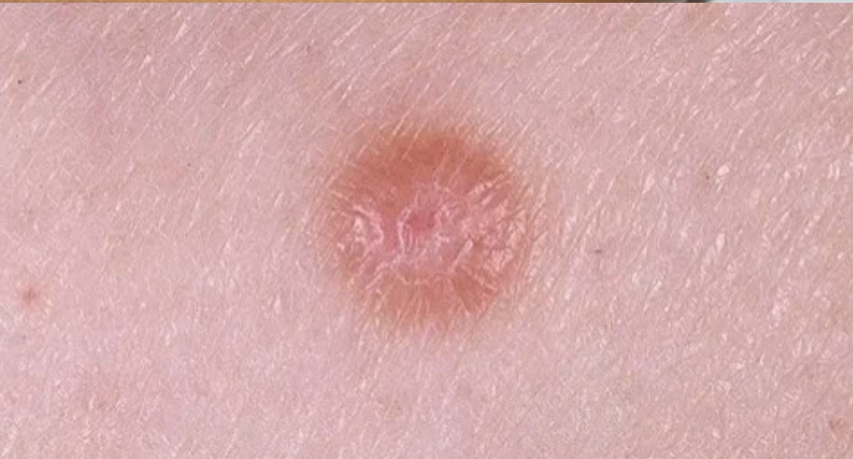 dermatofibroma