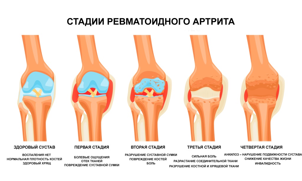 rarthritis3.jpg rarthritis3.jpg