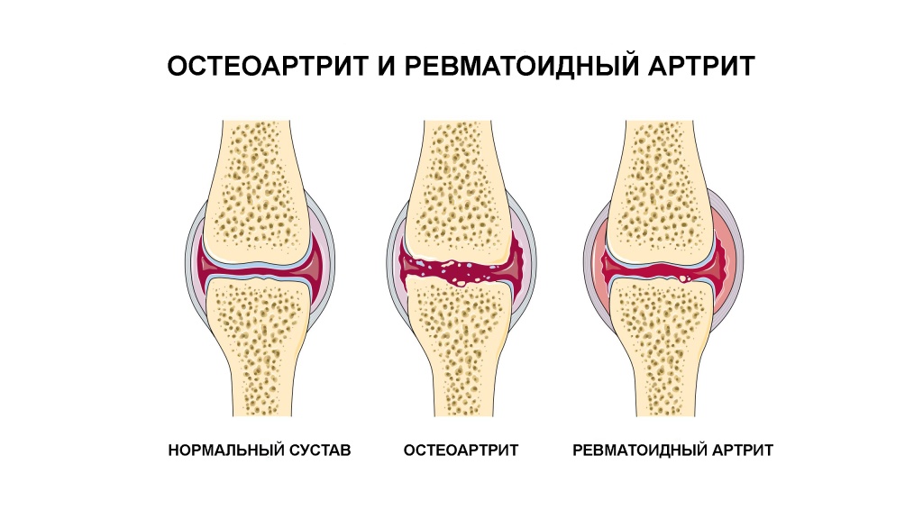 arthritis1.jpg arthritis1.jpg