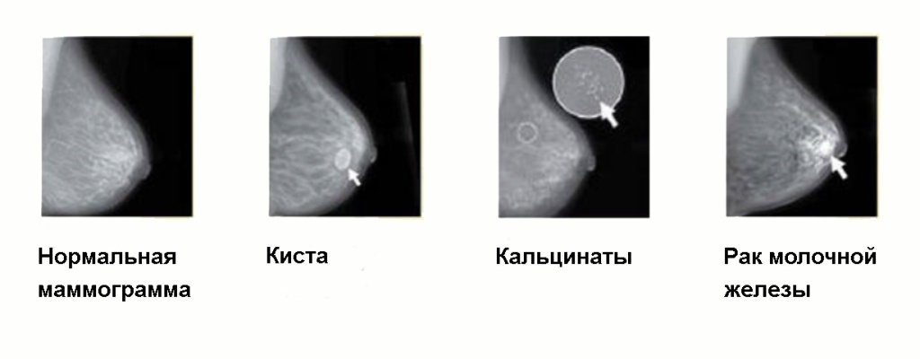 mammogram3.jpg