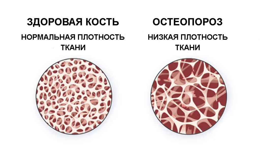 osteoporosis1.jpg osteoporosis1.jpg