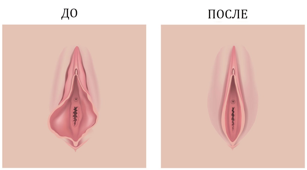 Пластика малых половых губ